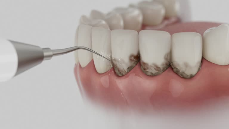 Trusted Teeth Cleaning And Checkup service in Granite Hills, CA - Dentist Open Now